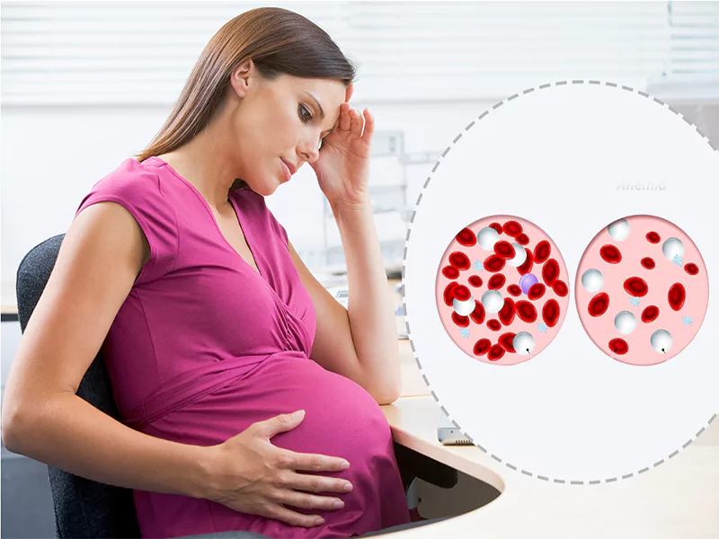 کم خونی در بارداری